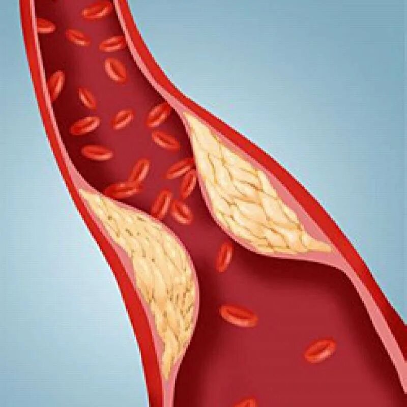 От бляшек и тромбов как очистить. Облитерирующий атеросклероз. Атеросклероз холестериновая бляшка. Атеросклероз (закупорка кровеносных сосудов). Атеросклеротическое поражение кровеносных сосудов.