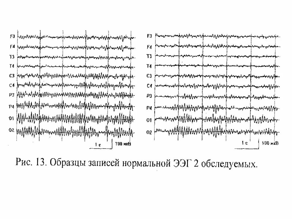 Ээг отзывы детям. Вертексные потенциалы на ЭЭГ. На ЭЭГ гипервентиляции норма. Полиспайки на ЭЭГ. ЭЭГ головного мозга пример.