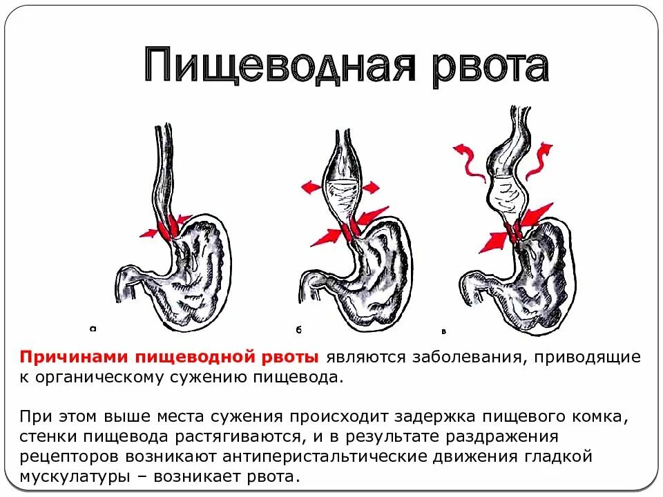 Почему появляется рвота. Пищеводная рвота. причины рвоты. тошнота и рвота причины. как происходит тошнота.