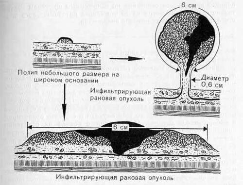 Микровезикулярный полип что это. Микровезикулярный полип что это