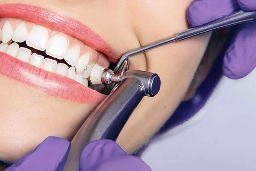 Крошка зуба. Профгигиена (ультразвук + Air-Flow). Профгигиена полости рта. Гигиена зубов. Профессиональная гигиена полости.