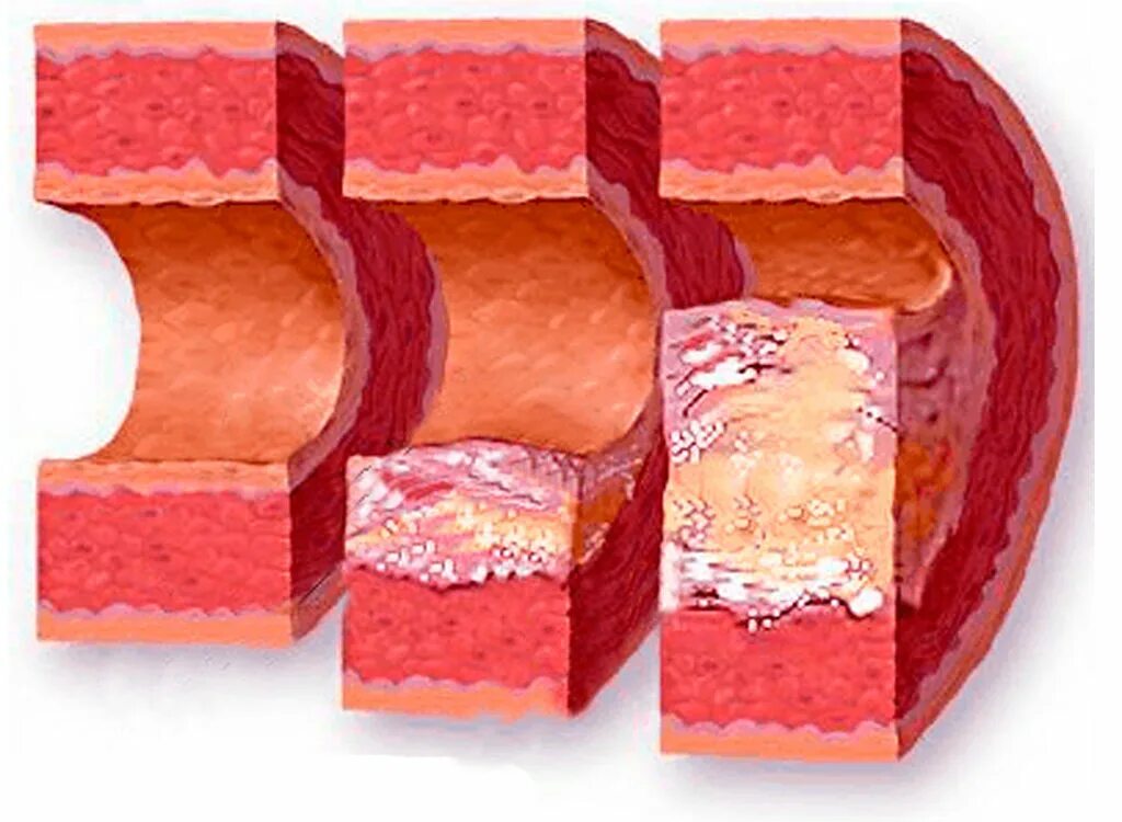 Отложение холестерина. Атеросклероз кардиосклероз. Атеросклероз аорты, атеросклеротический кардиосклероз. Атеросклероз и образование атеросклеротических бляшек. Атеросклероз холестериновая бляшка.