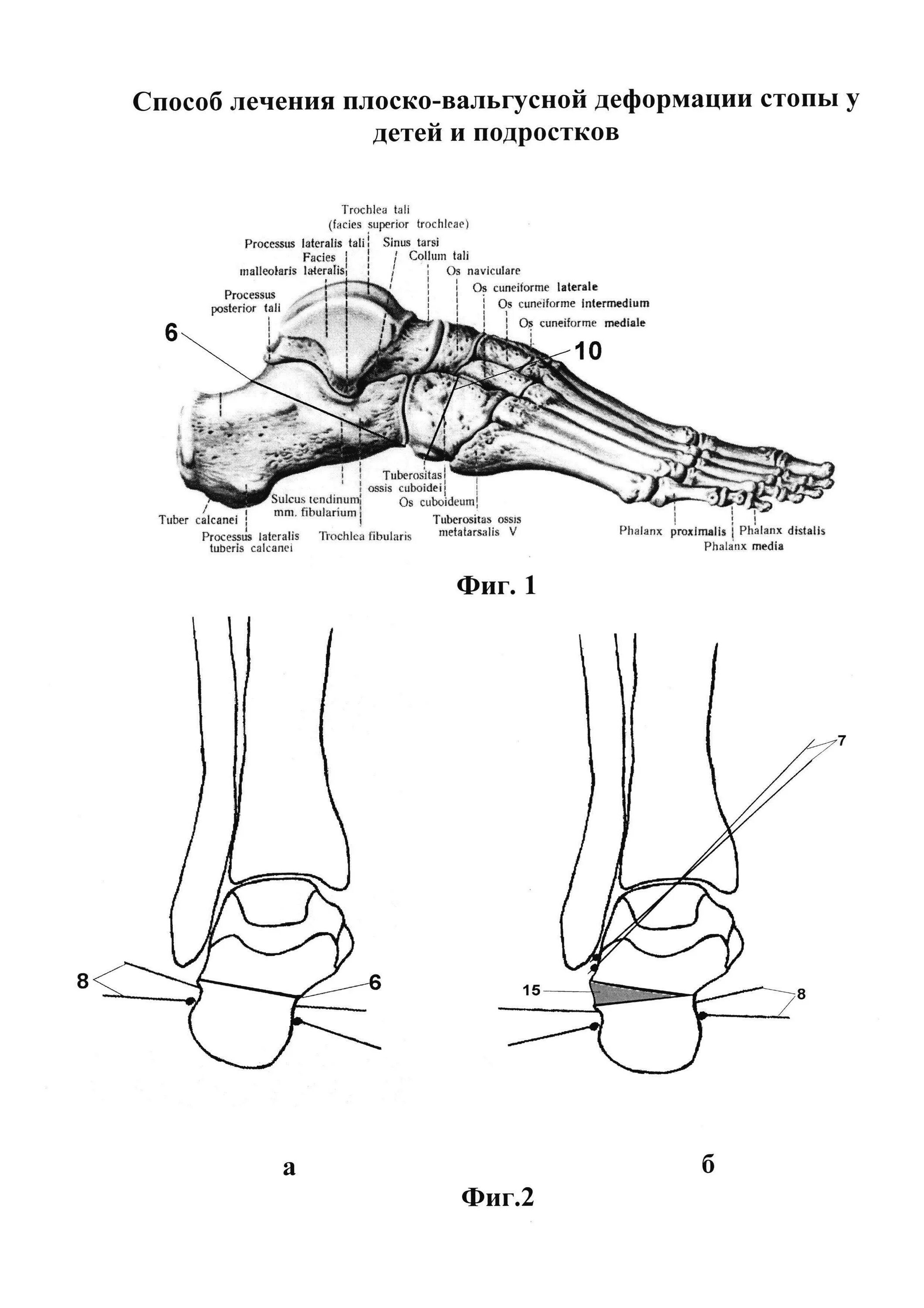 Плосковальгусной деформации стопы. Плосковальгусная деформация стоп у детей рентген. Операция косточки вальгусная деформация. Вальгусная деформация голеностопного сустава. Операция вальгусная реабилитация