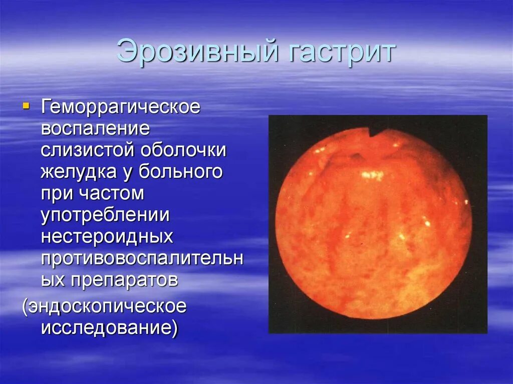 Эрозивно геморрагический гастрит. Геморрагические эрозии антрального отдела желудка. Острый эррозийный гастрит. Хронический гастрит воспаление