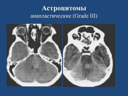 Астроцитома grade 3