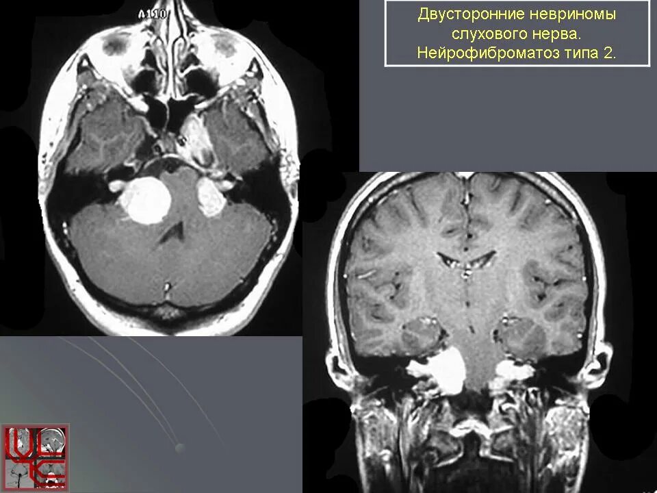 Мрт черепных нервов. Невринома 8 пары ЧМН. Шваннома слухового нерва кт. Акустическая шваннома мрт. Шваннома слухового нерва мрт.