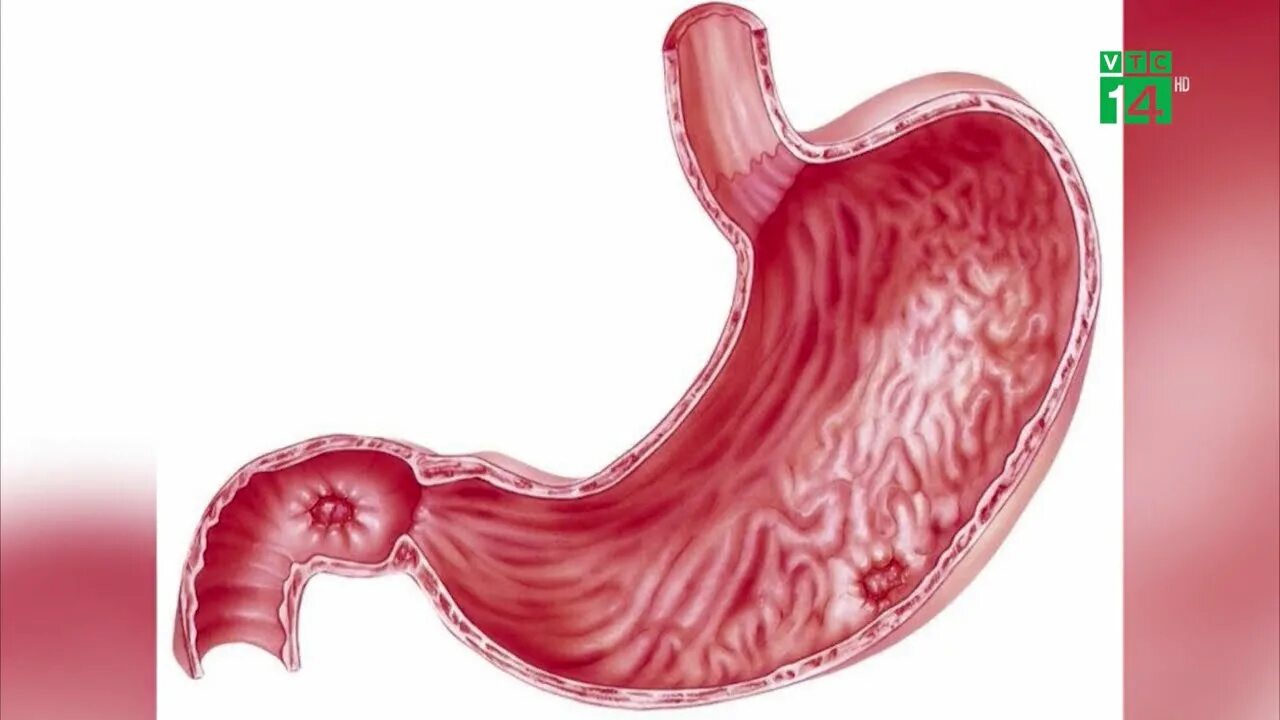 Язва желудка и 12 перстной кишки. Язва двенадцатиперстной кишки снимок. Язва 12 перстной кишки эндоскопия. Простуда желудка