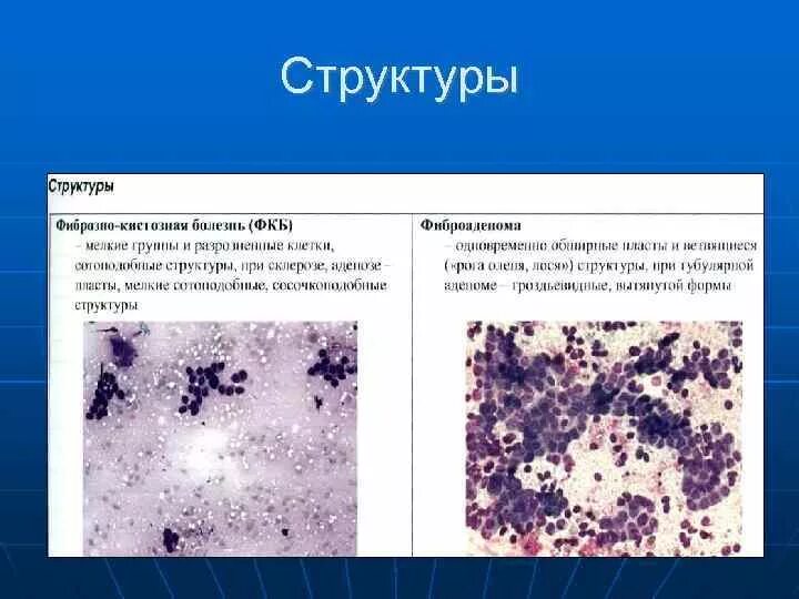 Макрофаги в молочной. Цитологическое исследование отделяемого молочной железы. Цитология исследование отделяемое молочной железы. Пунктат молочной железы цитологическое исследование. Бесструктурное вещество в цитологии.