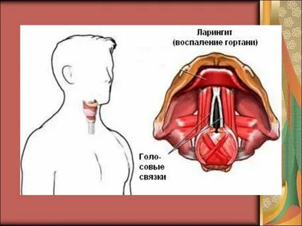 Лечение гортани