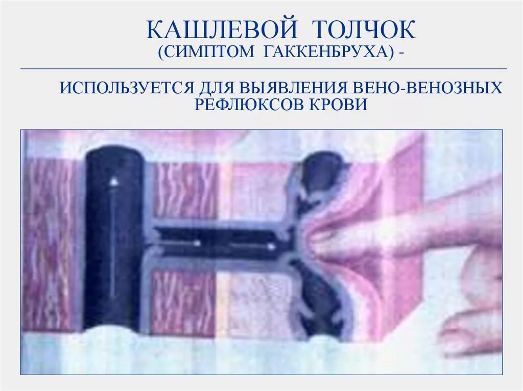 Симптом кашлевого толчка. Симптом кашлевого дочка. симптом кшлевого толвке. отрицательный симптом кашлевого толчка.