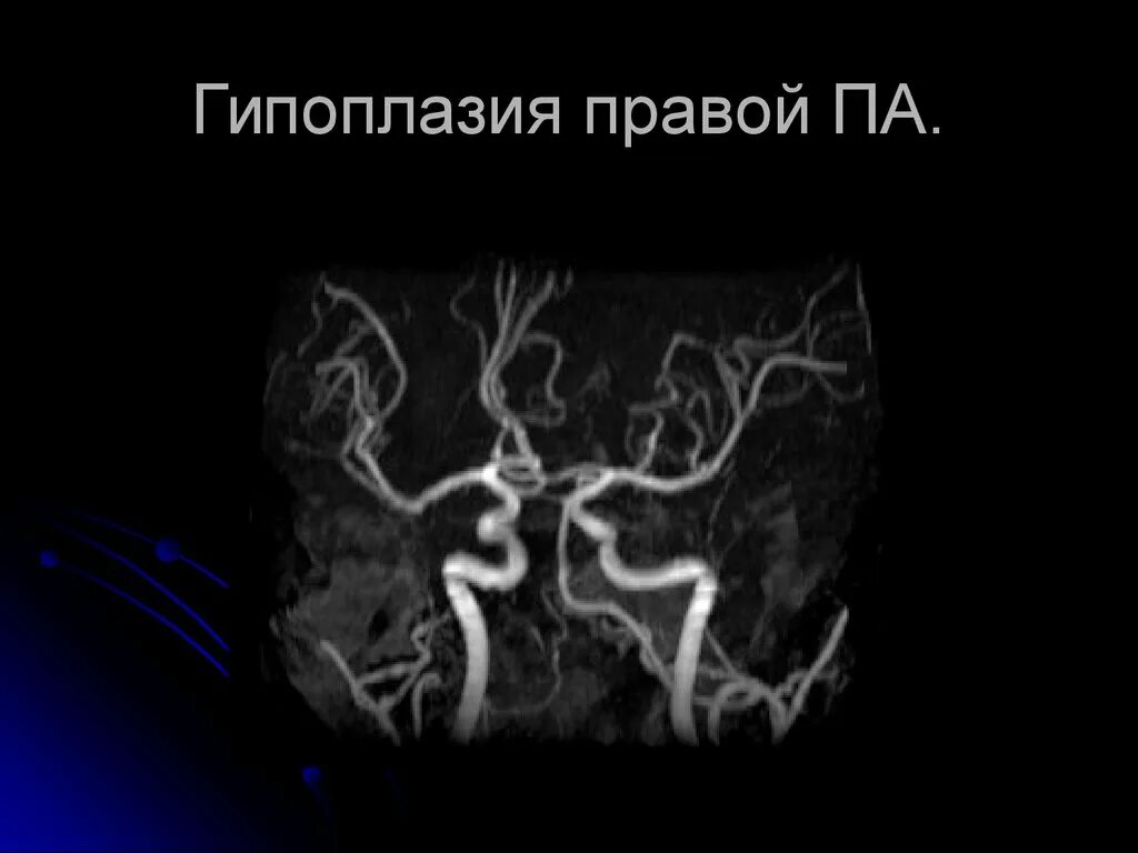 Гипоплазия правой артерии головного мозга. Гипоплазия позвоночной артерии мрт. Гипоплазия правой позвоночной артерии мрт. Аплазия позвоночной артерии. Гипоплазия правой передней передней мозговой артерии.