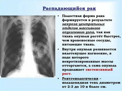 Кавернозно цирротический туберкулез