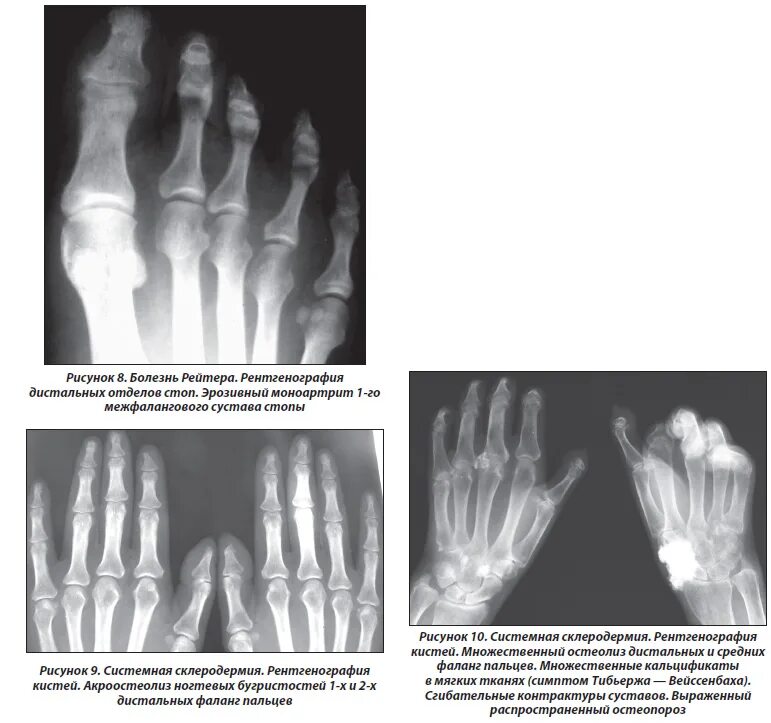 Болезнь рейтера что это. Склеродермия рентген кистей. Псориатический артрит рентген стоп. Системная склеродермия рентген кистей рук. Системная склеродермия стопа рентген.