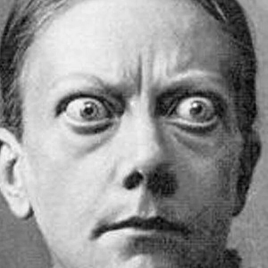 Клинические симптомы базедовой болезни. Базедова болезнь пучеглазие. Базедова базедова болезнь. Интермиттирующий экзофтальм. Базедова болезнь пучеглазие.