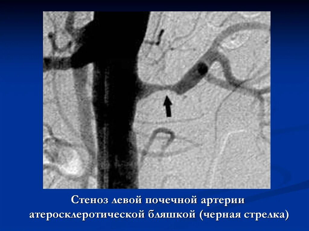 Стеноз артерии почки. Уздг почечных артерий стеноз. атеросклероз почечных артерий узи. стеноз почечной артерии на узи. фибромускулярная дисплазия.