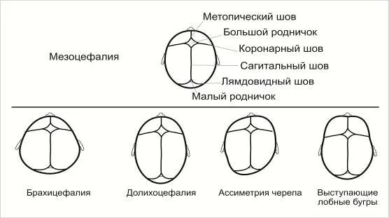 Затылок норма. Формы черепа человека долихоцефалия брахицефалия мезоцефалия. Форма черепа младенца мезоцефалия. Формы головы человека брахицефалия, мезоцефалия. Мезоцефалический Тип строения черепа.