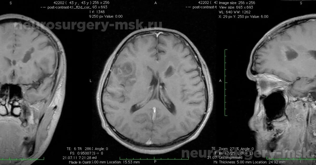 Образование в лобной доле. Глиобластома лобной доли. Глиобластома головного мозга на кт.