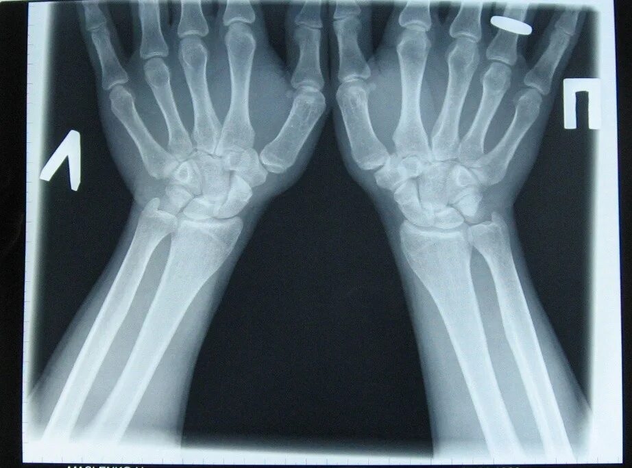 Лучевая трещина. Лучезапястный сустав рентген. Лучевая кость перелом рентген. Рентген перелома лучевой кости руки. Перелом кости лучезапястного сустава.