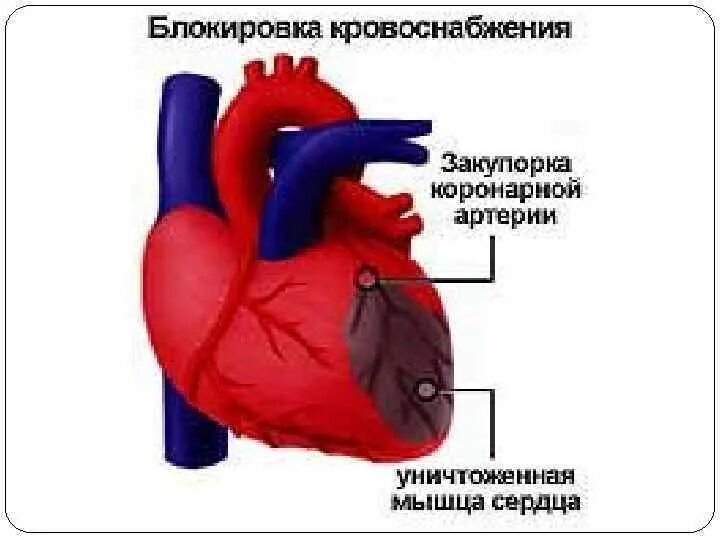 Как выглядит сердце после инфаркта. Нарушение кровоснабжения миокарда. кровоснабжение сердца и инфаркт. сердце после инфаркта миокарда.