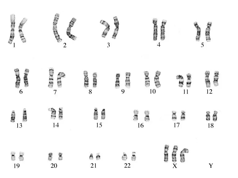 Трипло х. Синдром трисомии х хромосомы кариотип. Синдром трисомия х кариотип. Синдром трисомии по х-хромосоме кариотип. Синдром трипло-х кариотип.