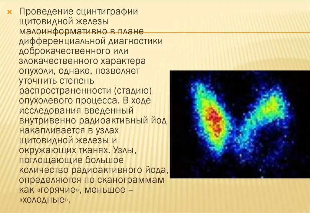 Гипотиреоз сцинтиграфия. Сцинтиграфия щитовидной железы контрастирование. Радиоизотопная сцинтиграфия щитовидной железы. Сцинтиграфия с радиоактивным йодом. Злокачественный характер