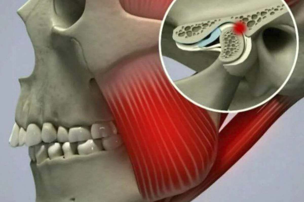 Почему может болеть челюсть. Челюстью(дисфункция ВНЧС). Дисфункция височно-нижнечелюстного сустава (ВНЧС). Гнатология ВНЧС. Мышечная дисфункция ВНЧС.