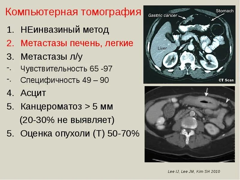 3 метастазы в печени