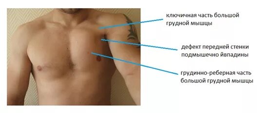 Разрыв мышц грудной клетки. Растяжение большой грудной мышцы.