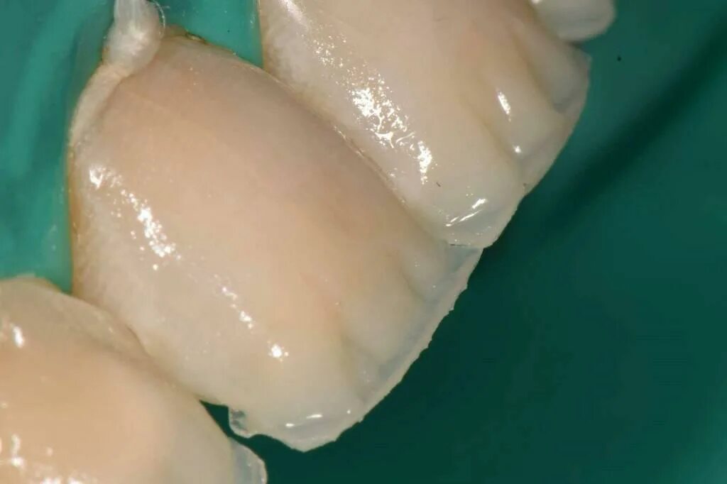Композитные материалы для фронтальной группы зубов. Реставрация режущего края зубов. Восстановление стенки зуба. Реставрация фронтальной группы зубов. Материал для реставрации зубов