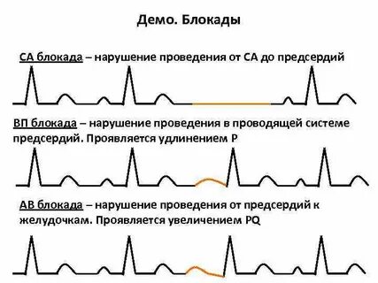 Блокада признаки