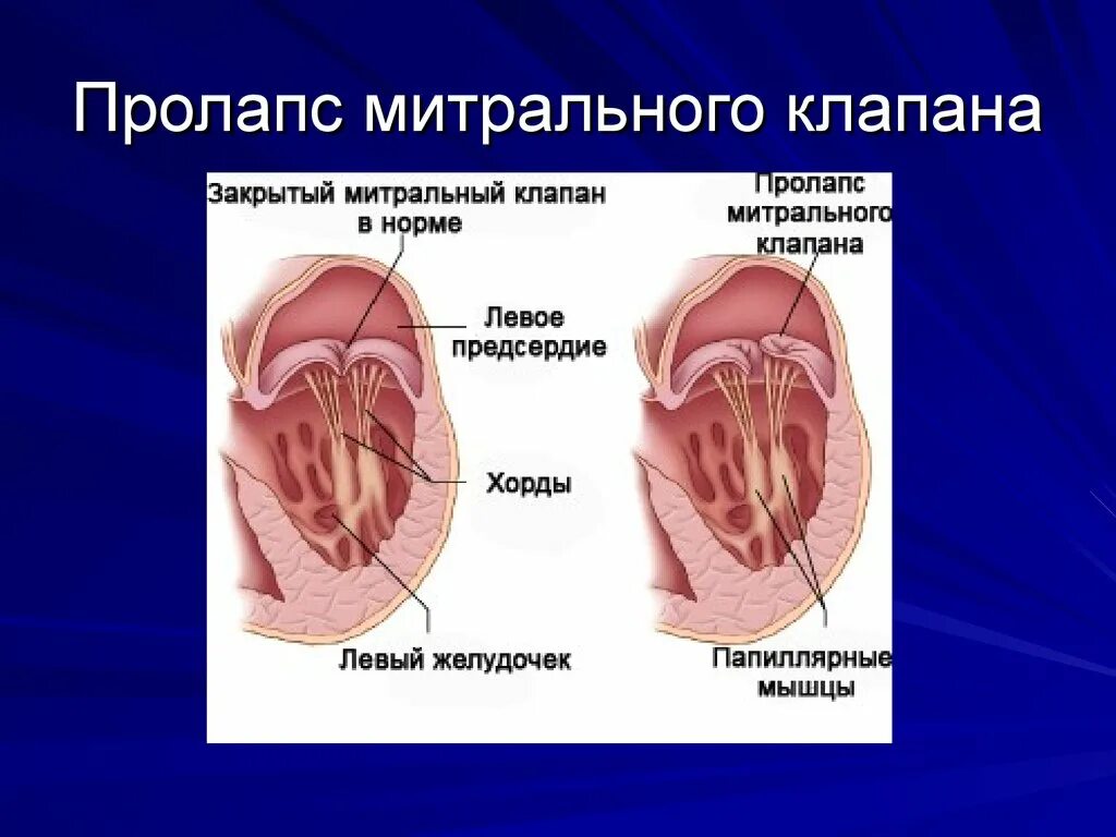 Что такое пролапс митрального клапана. Пролапс хорды митрального клапана. Пролапс створки митрального клапана. Пролапс передней створки митрального клапана до 4мм. Пролапс задней створки митрального клапана.