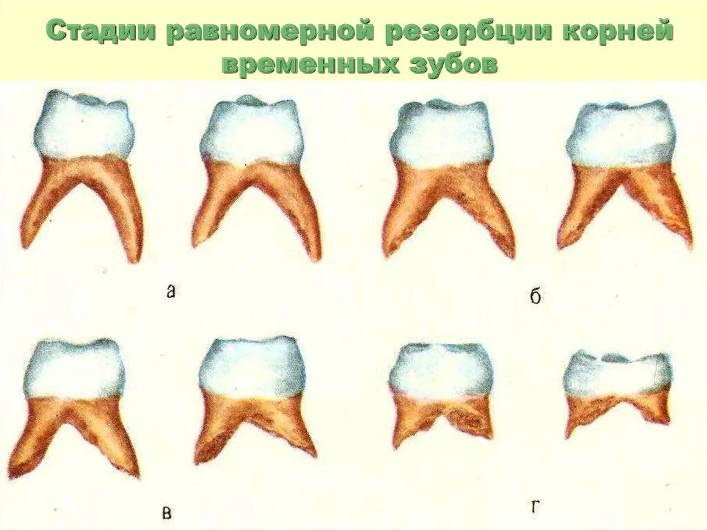 Боковой резец верхней челюсти кариес. Пришеечный кариес верхних резцов. Кариес корня молочного зуба. Первый моляр верхней кариес зубов.