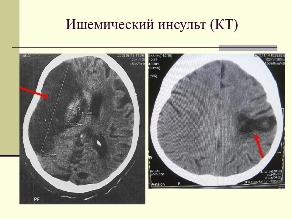 Очаги ишемии головного мозга. Инсульт ишемический ишемический инсульт. Очаг поражения при ишемическом инсульте. Ишемический инсульт на кт головного мозга. Геморрагический инсульт кт.