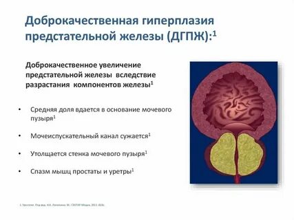 Что такое аденома предстательная железа