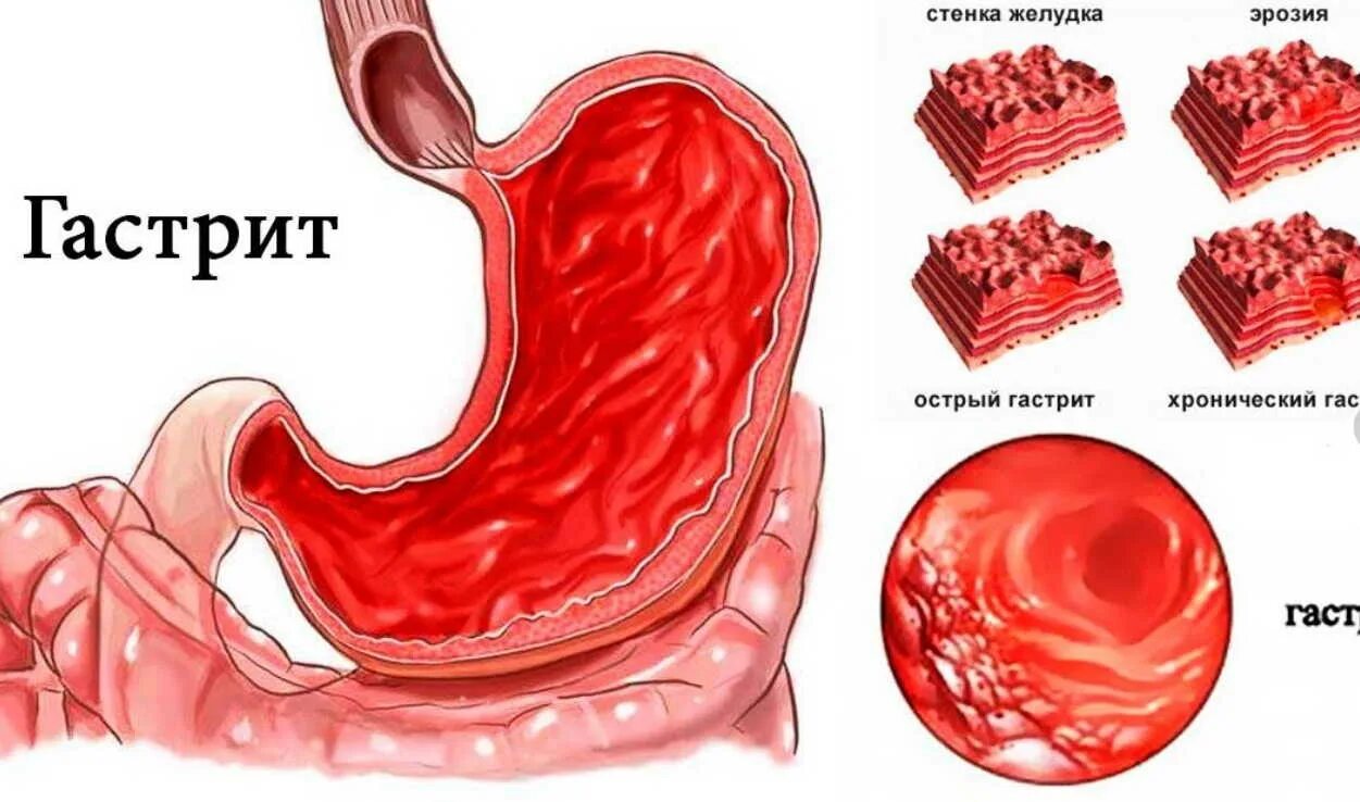 Формы острого гастрита. Катаральный гастродуоденит. Острый и хронический гастрит.