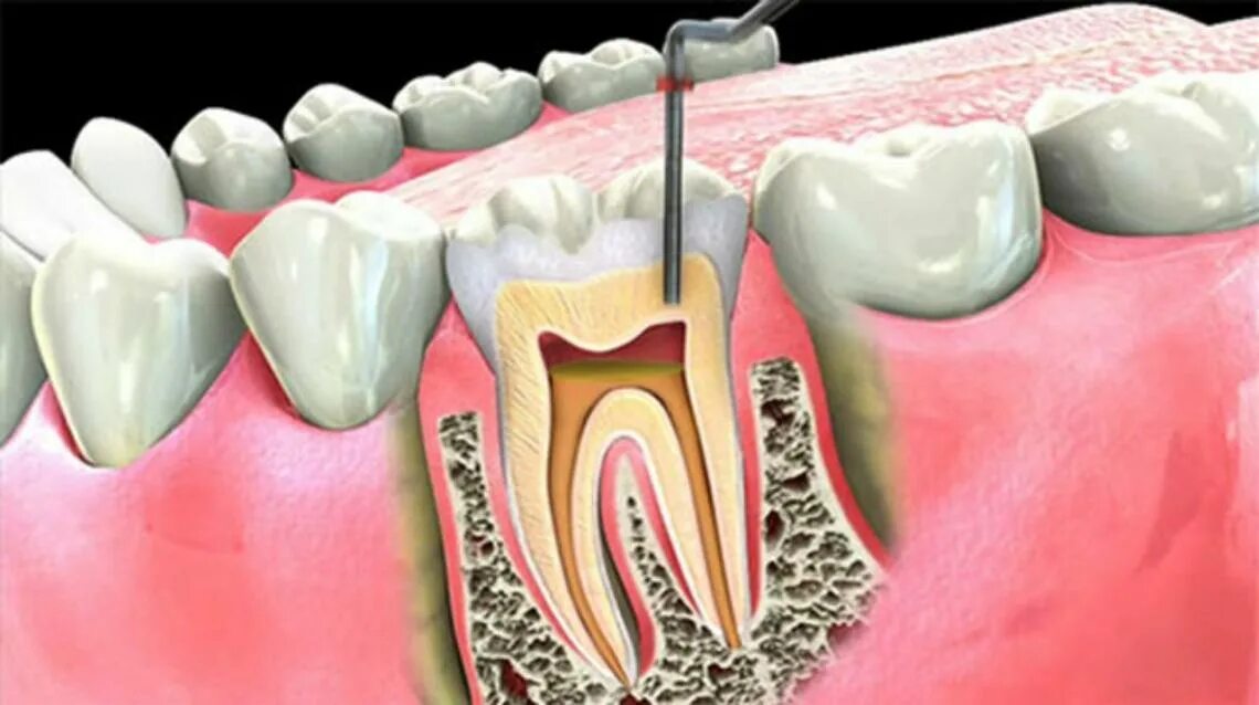 Root canal. 4 Канальный пульпит зуба. Пульпит зуба чистка канала.