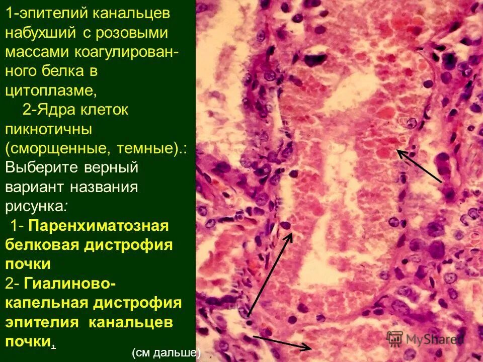 Дегенерация клеток. Гидропическая дистрофия эпителия канальцев почки. Гиалиново-капельная дистрофия почек макропрепарат. Вакуольная гидропическая дистрофия гистология. Микропрепарат гидропическая дистрофия эпителия канальцев.