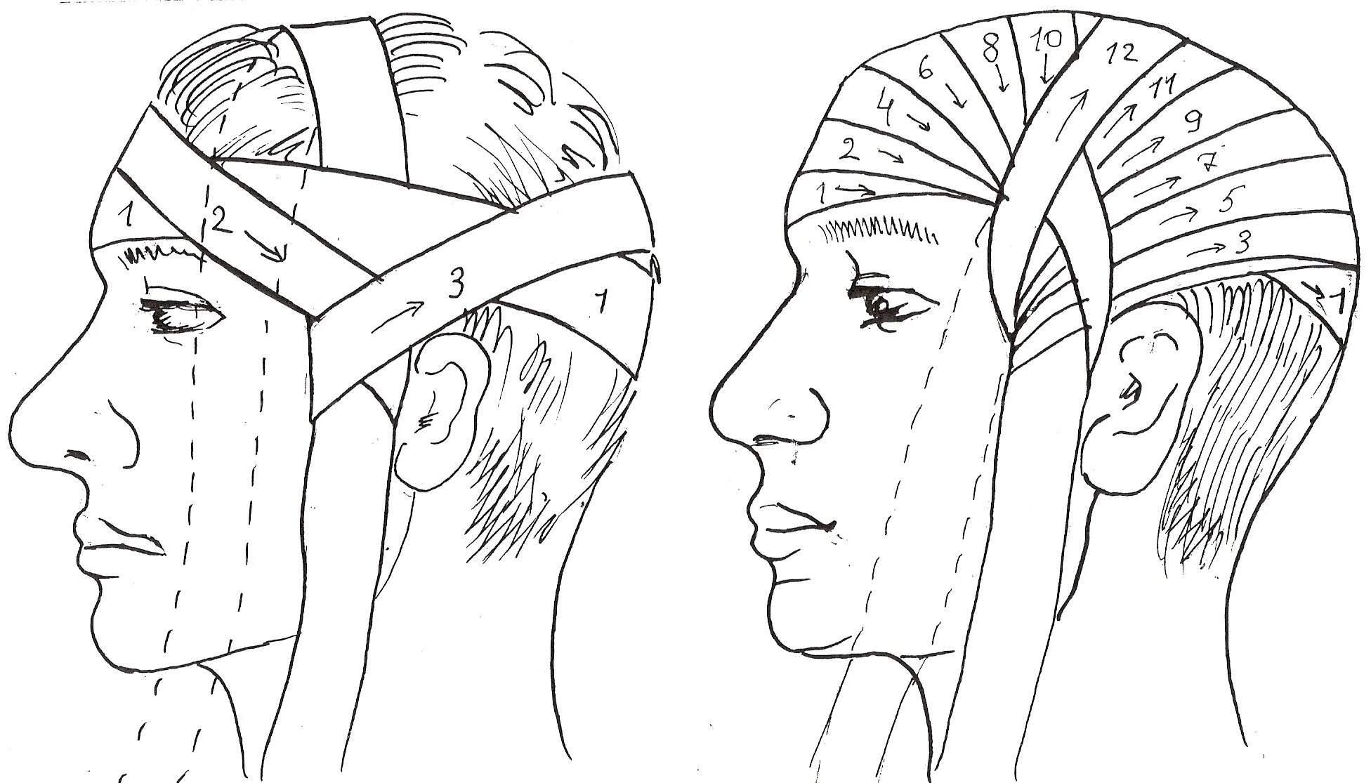 перевязка головы бинтом чепец. чепец бинтование. перевязка головы чепец. наложение повязки уздечка алгоритм. перевязка головы чепец.