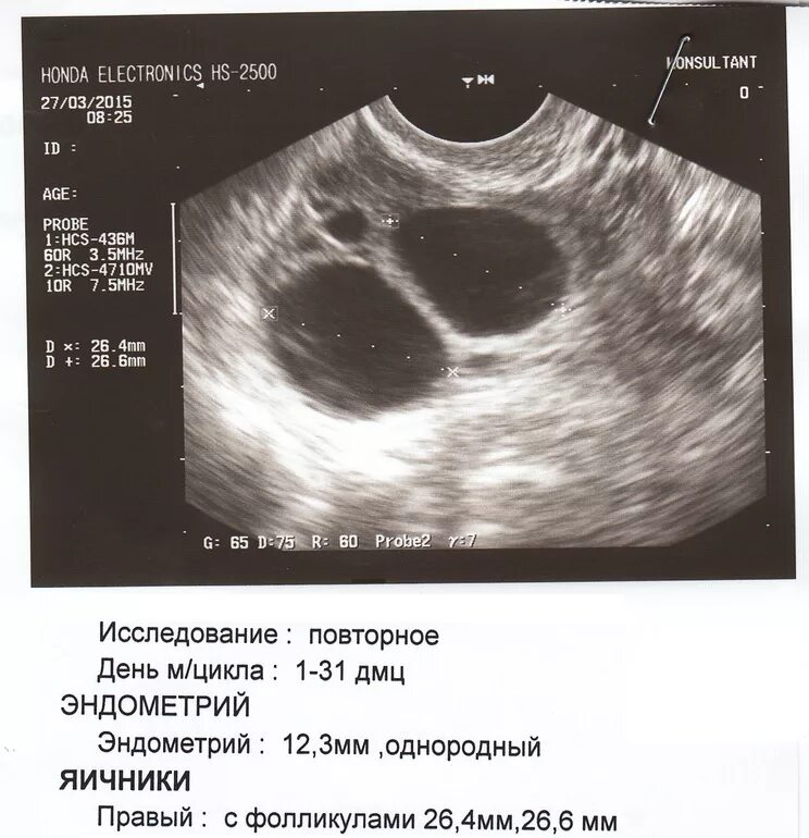 Доминантный фолликул 21мм. Эндометрий 13 мм фолликул 25 мм. Доминантный фолликул 17 мм на УЗИ. Фолликул 26 мм эндометрий 10 мм. Фолликул яичника размеры