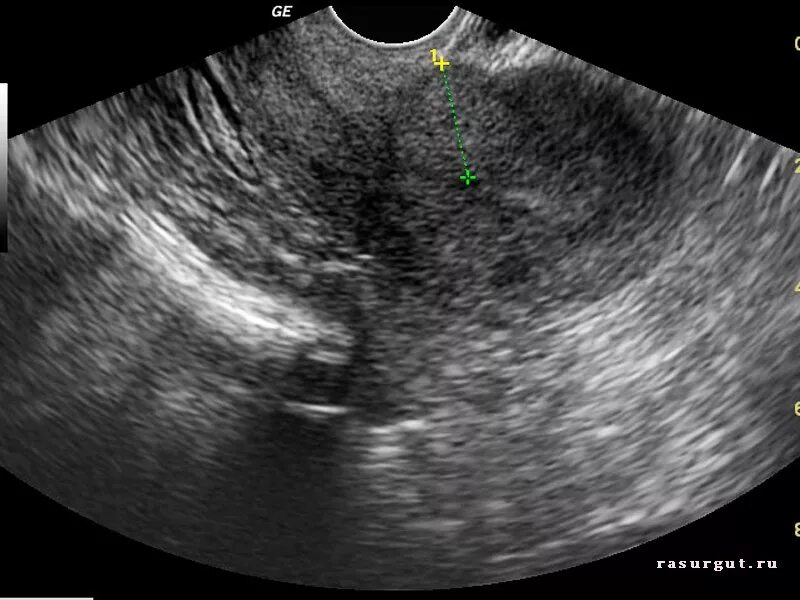 миома 11 недель