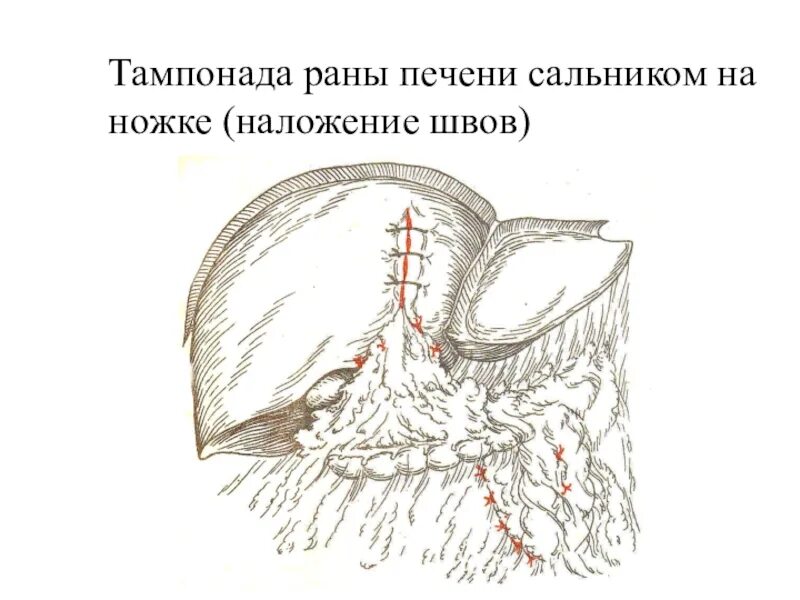 Тампонада раны при кровотечении. Тампонада печени сальником.