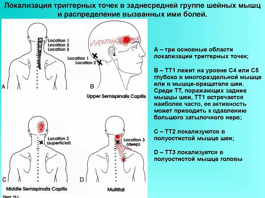 Болит плечо отдает в голову. Ременная мышца головы триггерные точки. Мышцы шеи триггерные точки схема.