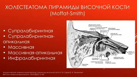 Операция височных костей
