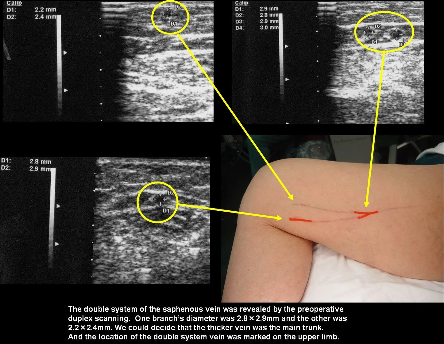 Узи дема. Допплеровское сканирование сосудов нижних конечностей. Ультразвуковое ангиосканирование артерии нижних конечностей. Ультразвуковое допплеровское исследование нижних конечностей. Ультразвуковая допплерография артерий при тромбе.