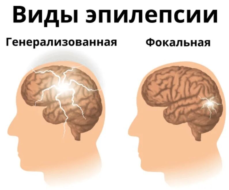 Эпилепсия типы приступов. Эпилепсия типы припадков. Формы приступов эпилепсии. Типы приступов при эпилепсии.