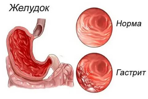 1 острый гастрит