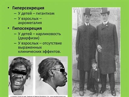 Гигантизм сахарный диабет