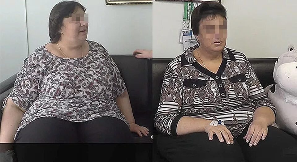 Резекция желудка махачкала. Резекция желудка для похудения до и после. резекция желудка для похудения фото. резекция желудка до и после фото. резекция желудка для похудения фото до и после.