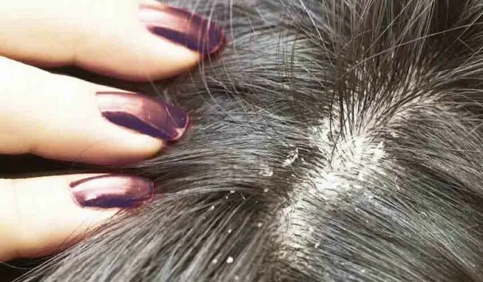 Заболевание кожи головы фото лечение File:Frontal linear scleroderma  Wikipedia