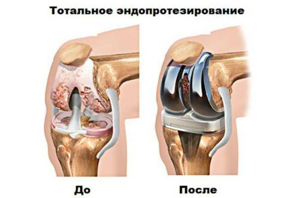 Ограничения после эндопротезирования. Асептический некроз коленного сустава классификация. Гонартроз коленного сустава мрт. Эндопротезирование тазобедренного сустава тотальное (схема 1). Эндопротезирование тазобедренного сустава DEPUY.